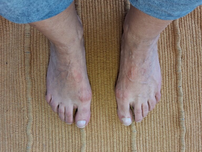 Pieds touchés par un hallux valgus sans orthoplasties