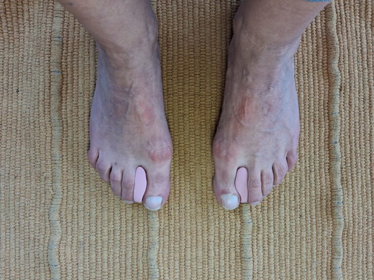 Pieds touchés par un hallux valgus avec des orthoplasties