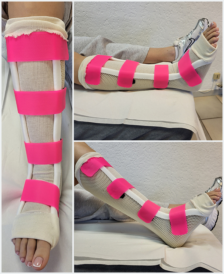 Orthèse botte en matériaux thermoformé