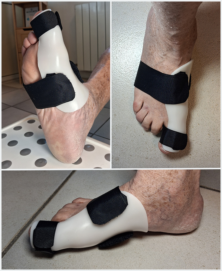 Orthèse correctrice d'hallux valgus en matériaux thermoformé
