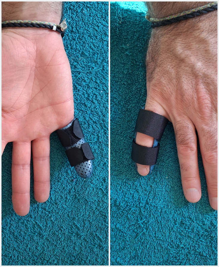 Orthèse de doigts en matériaux thermoformé