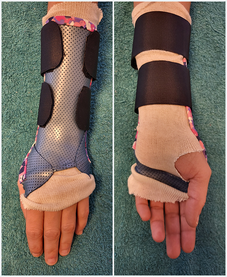 Orthèse dorso palmaire en matériaux thermoformé