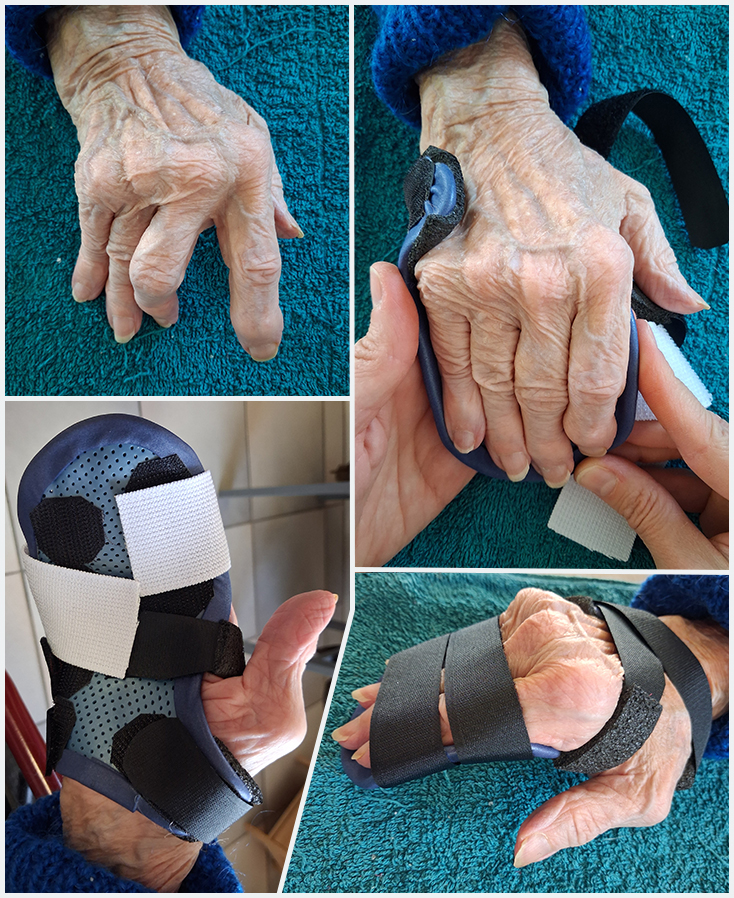 Orthèse gantelet palmaire en matériaux thermoformé