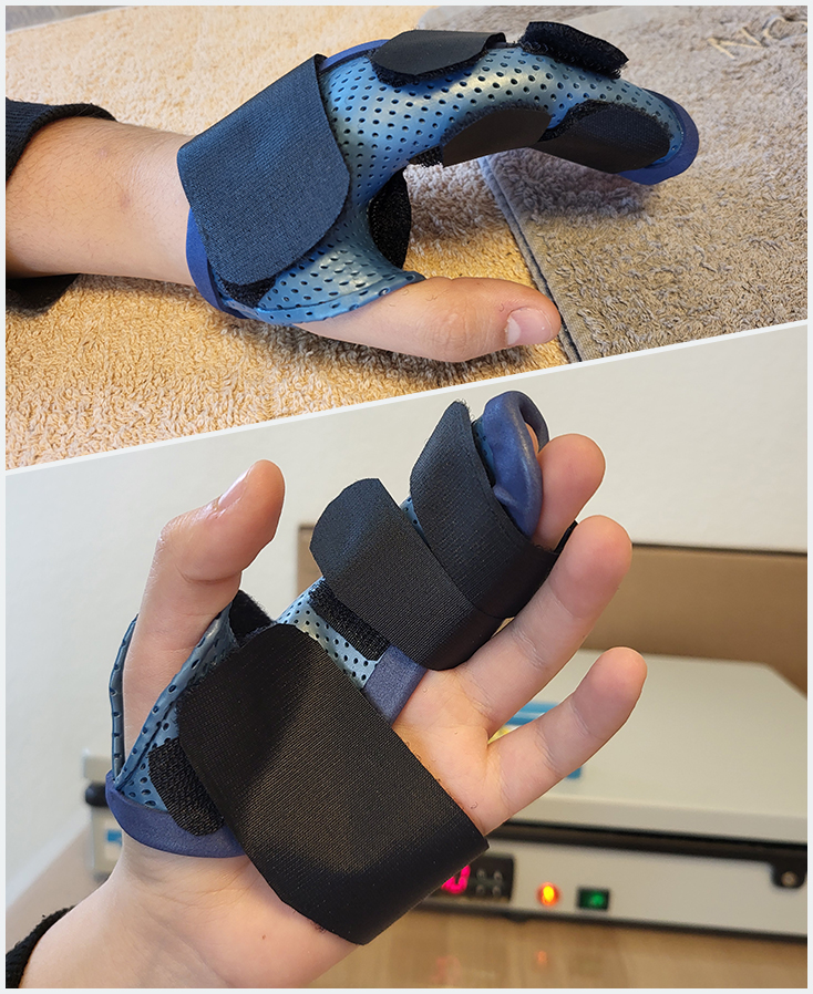 Orthèse gantelet avec syndactylie en matériaux thermoformé