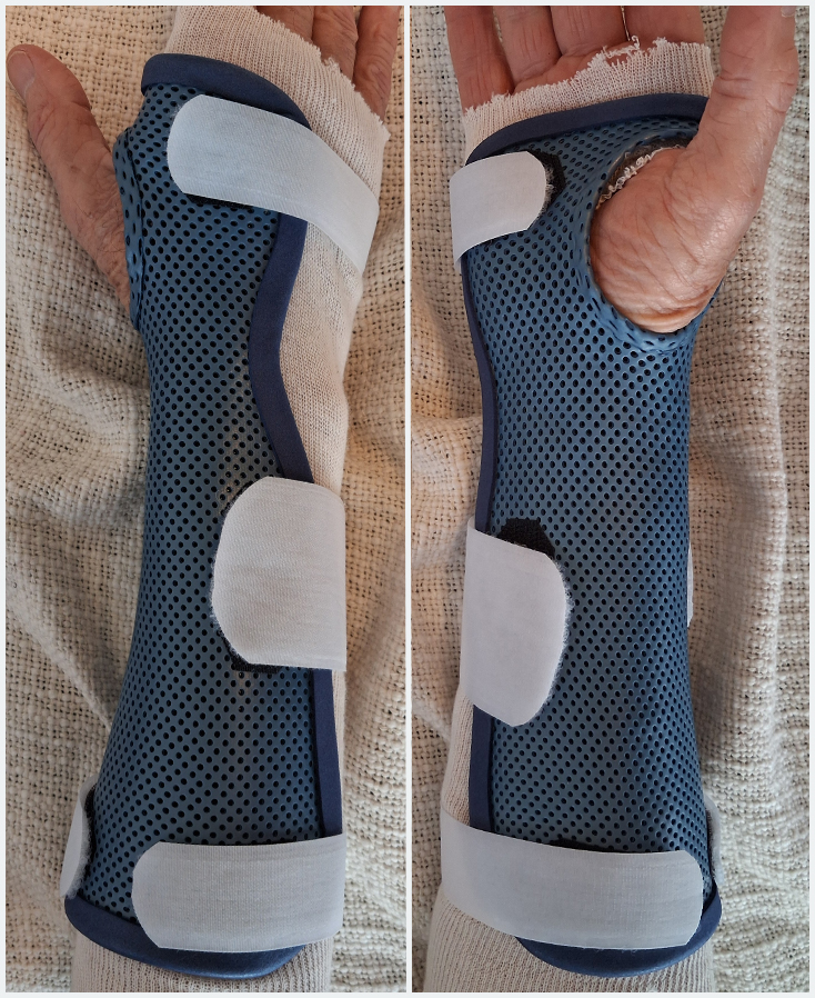 Orthèse de poignet en matériaux thermoformé