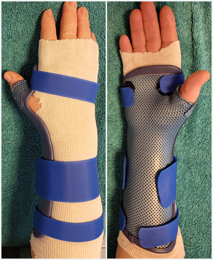 Orthèse de poignet pouce en matériaux thermoformé