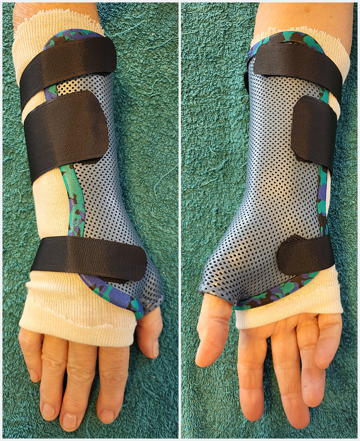 Orthèse de poignet pouce en matériaux thermoformé