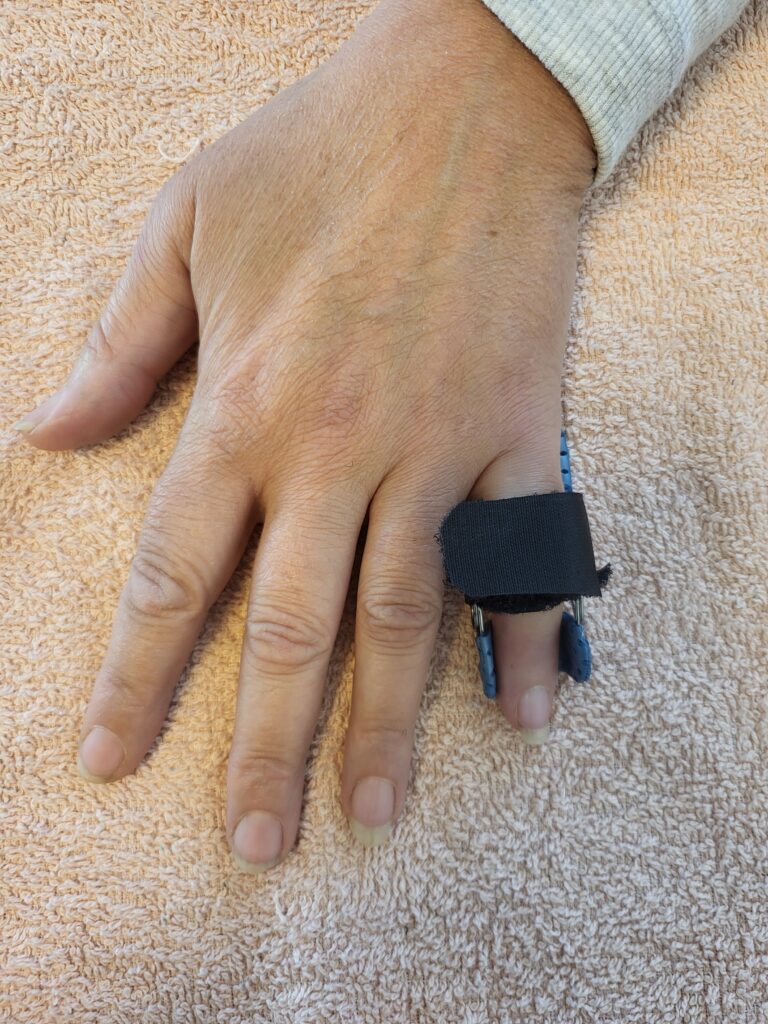 Orthèses thermoformées 20260223 160132