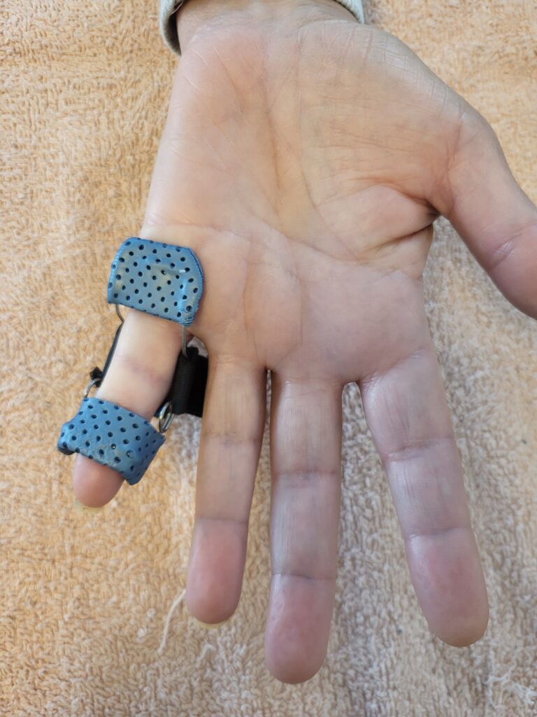 Orthèses thermoformées 20260223 160138